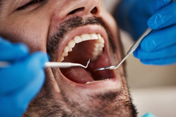 Best Emergency Dental Care for Sports Injuries in Maple Heights Lake Desire, WA